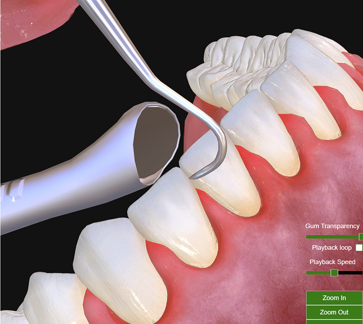 DHLOSCE partial open  mouth